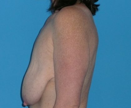 Breast Reduction Before & After Patient #1139