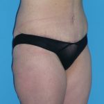 Tummy Tuck Before & After Patient #1339