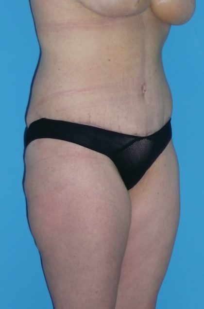 Tummy Tuck Before & After Patient #1339