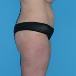 Tummy Tuck Before & After Patient #1339