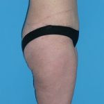 Tummy Tuck Before & After Patient #1339