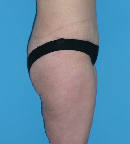 Tummy Tuck Before & After Patient #1339