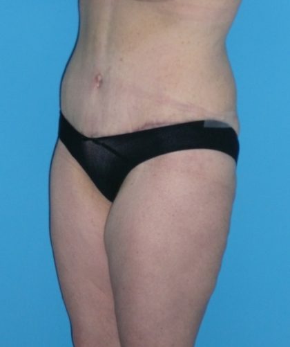 Tummy Tuck Before & After Patient #1339