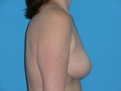 Breast Reduction Before & After Patient #1139