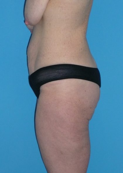 Tummy Tuck Before & After Patient #1339