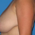 Breast Reduction Before & After Patient #1150