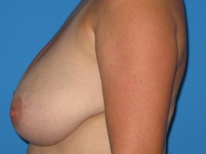 Breast Reduction Before & After Patient #1150