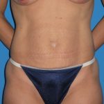 Tummy Tuck Before & After Patient #1352