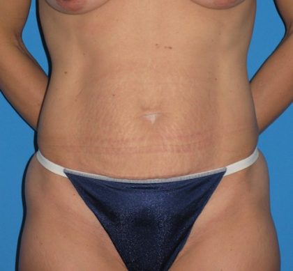 Tummy Tuck Before & After Patient #1352