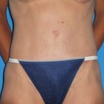 Tummy Tuck Before & After Patient #1352