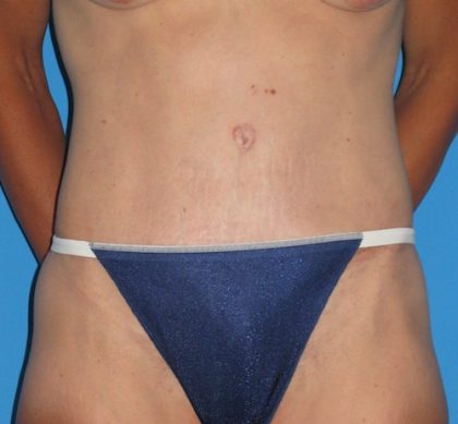 Tummy Tuck Before & After Patient #1352