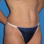 Tummy Tuck Before & After Patient #1352