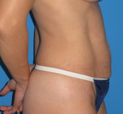 Tummy Tuck Before & After Patient #1352