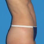 Tummy Tuck Before & After Patient #1352