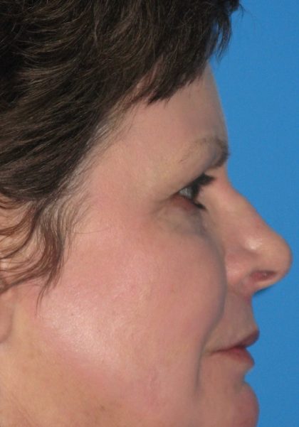 CO2 Laser Before & After Patient #1448