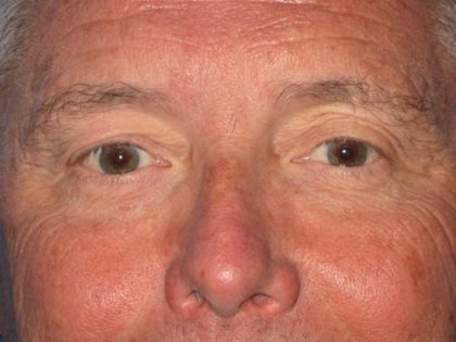 Blepharoplasty Before & After Patient #1419