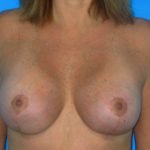 Breast Augmentation with Lift Before & After Patient #1083