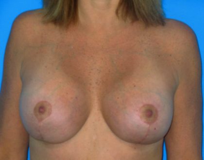 Breast Augmentation with Lift Before & After Patient #1083