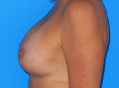 Breast Augmentation with Lift Before & After Patient #1083