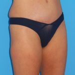 Tummy Tuck Before & After Patient #1359