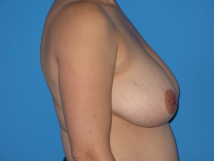Breast Reduction Before & After Patient #1168