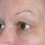 Blepharoplasty Before & After Patient #1426