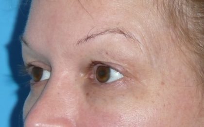 Blepharoplasty Before & After Patient #1426
