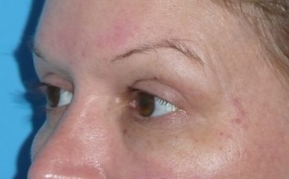 Blepharoplasty Before & After Patient #1426