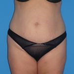 Tummy Tuck Before & After Patient #1381