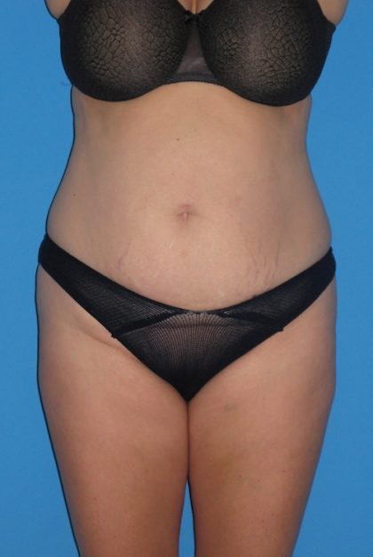 Tummy Tuck Before & After Patient #1381