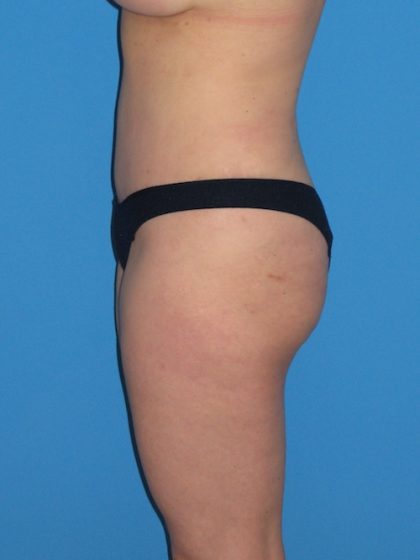 Tummy Tuck Before & After Patient #1381