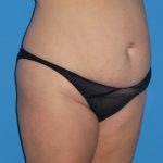 Tummy Tuck Before & After Patient #1381