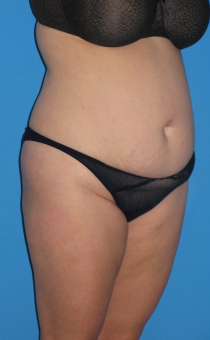 Tummy Tuck Before & After Patient #1381