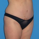 Tummy Tuck Before & After Patient #1381