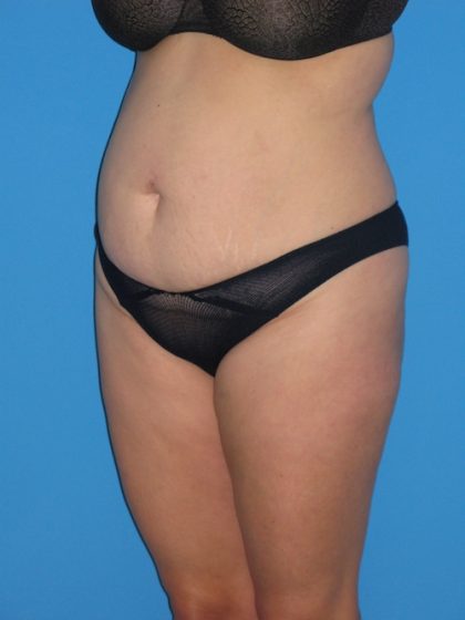 Tummy Tuck Before & After Patient #1381