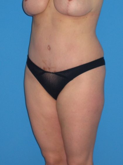 Tummy Tuck Before & After Patient #1381
