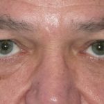Blepharoplasty Before & After Patient #1429