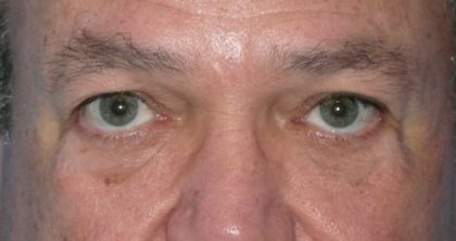 Blepharoplasty Before & After Patient #1429