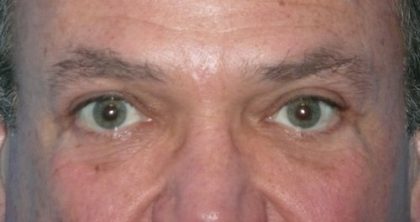 Blepharoplasty Before & After Patient #1429