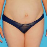 Tummy Tuck Before & After Patient #1372