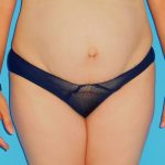 Tummy Tuck Before & After Patient #1372