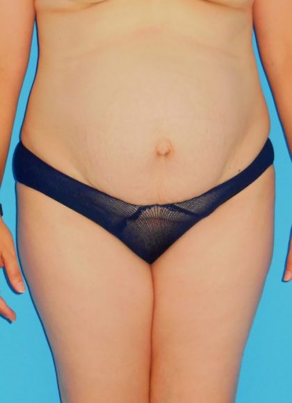 Tummy Tuck Before & After Patient #1372