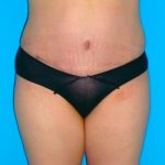 Tummy Tuck Before & After Patient #1372