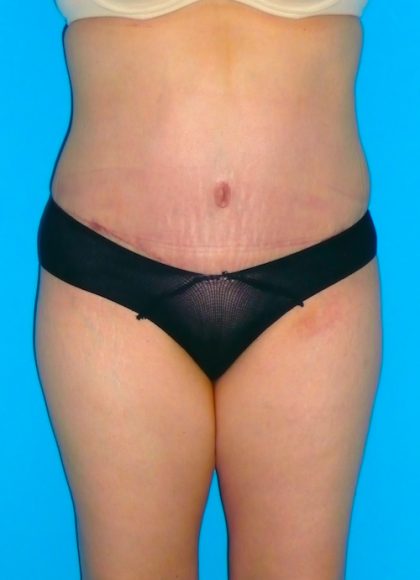 Tummy Tuck Before & After Patient #1372