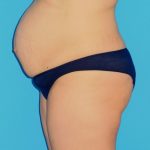 Tummy Tuck Before & After Patient #1372