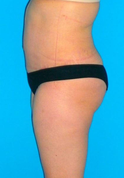 Tummy Tuck Before & After Patient #1372