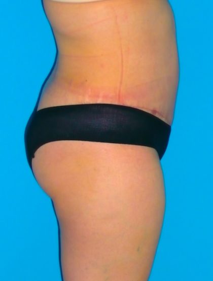 Tummy Tuck Before & After Patient #1372