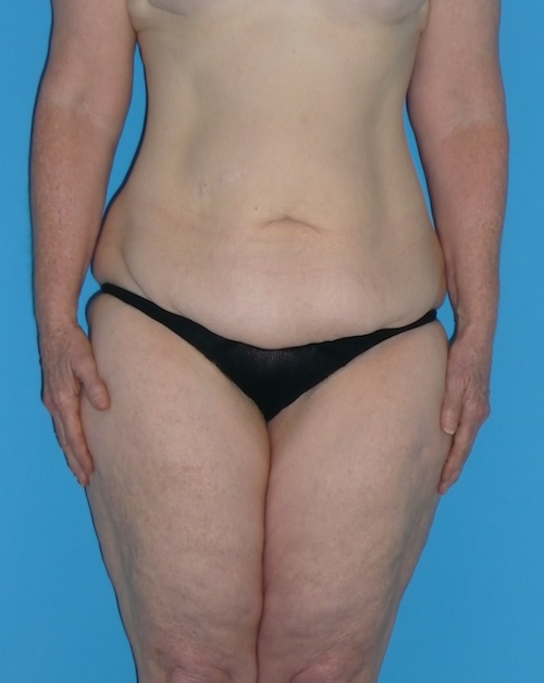 Body Lift Before & After Patient #1282