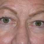 Blepharoplasty Before & After Patient #1434