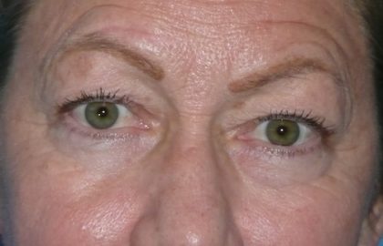 Blepharoplasty Before & After Patient #1434